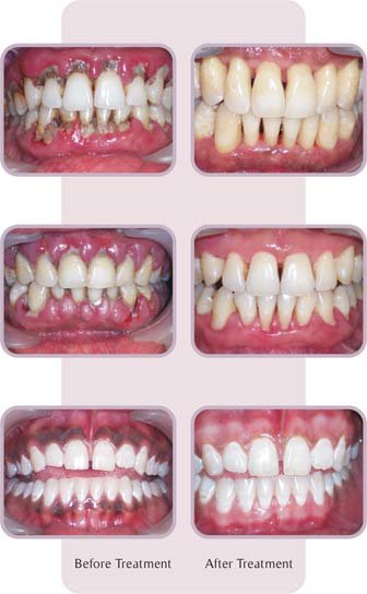 brocken teeth treatments manjeri