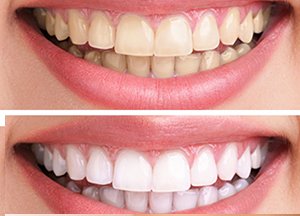 jaw shift treatments manjeri