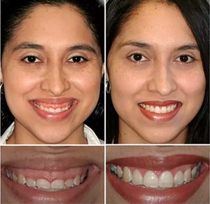 space of teeth treatments manjeri