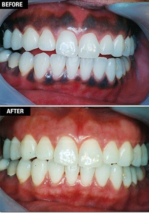 mouth breathing treatments manjeri